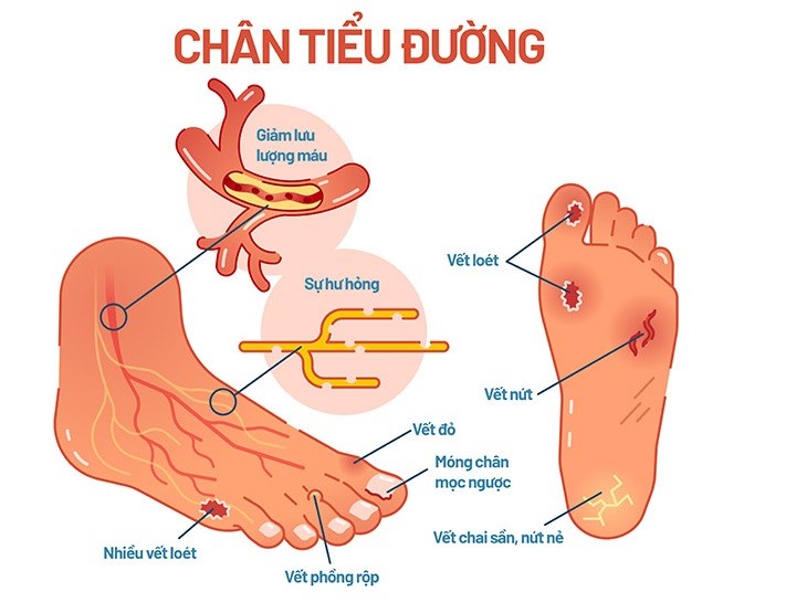 Liệu pháp oxy cao áp (HBOT) có thúc đẩy việc chữa lành vết loét bàn chân do tiểu đường không?